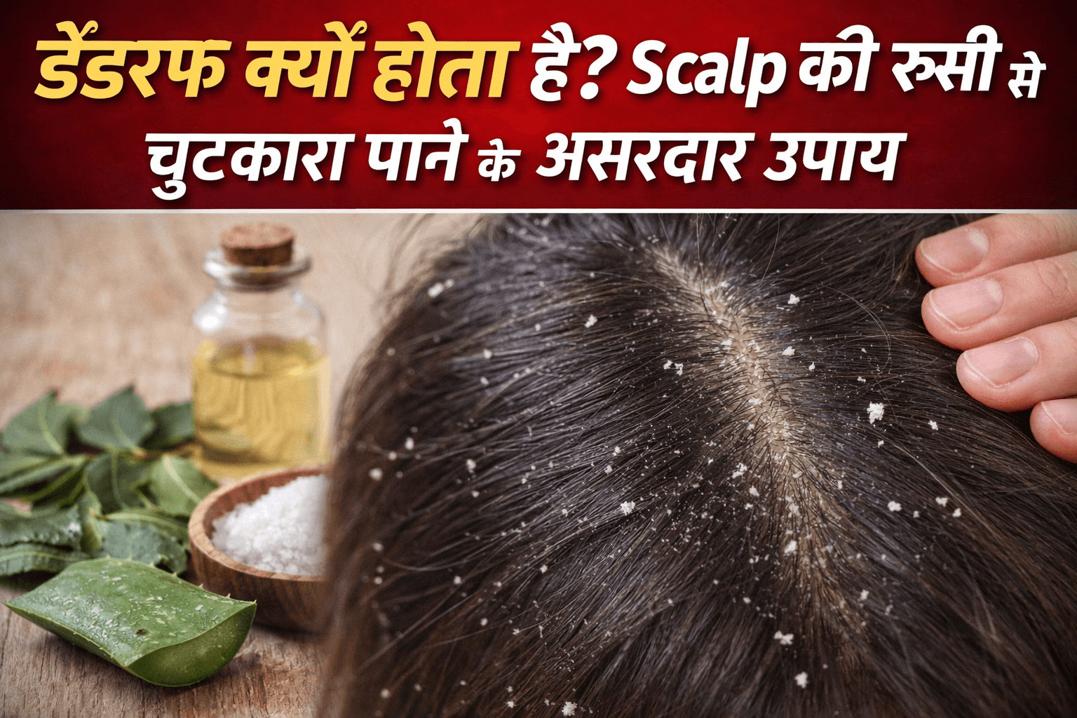 डैंड्रफ से प्रभावित स्कैल्प और रूसी के flakes का क्लोज़-अप दृश्य